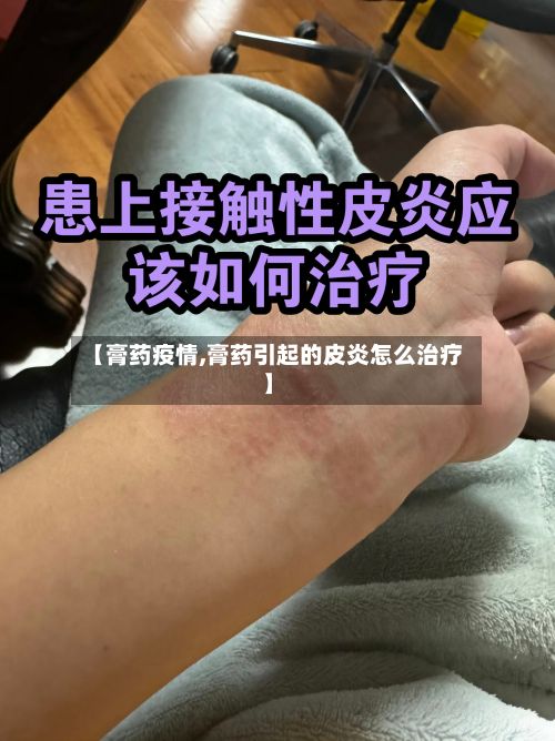 【膏药疫情,膏药引起的皮炎怎么治疗】-第3张图片